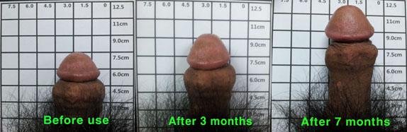 penis enlargement before and after 